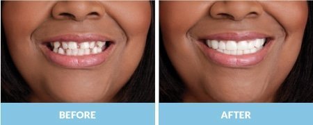 snap-on-smile4-1.jpg