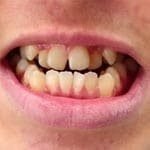 snap-on-smile-5-1.jpg