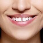 snap-on-smile-6-1.jpg